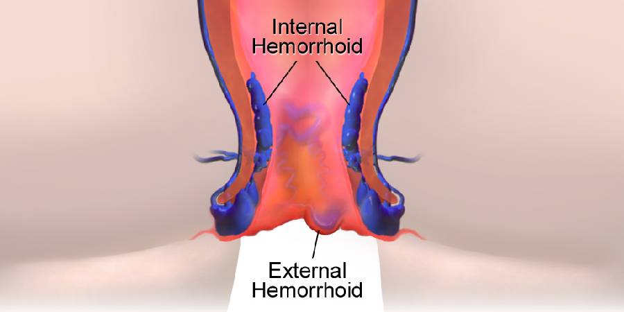 What are Hemorrhoids?